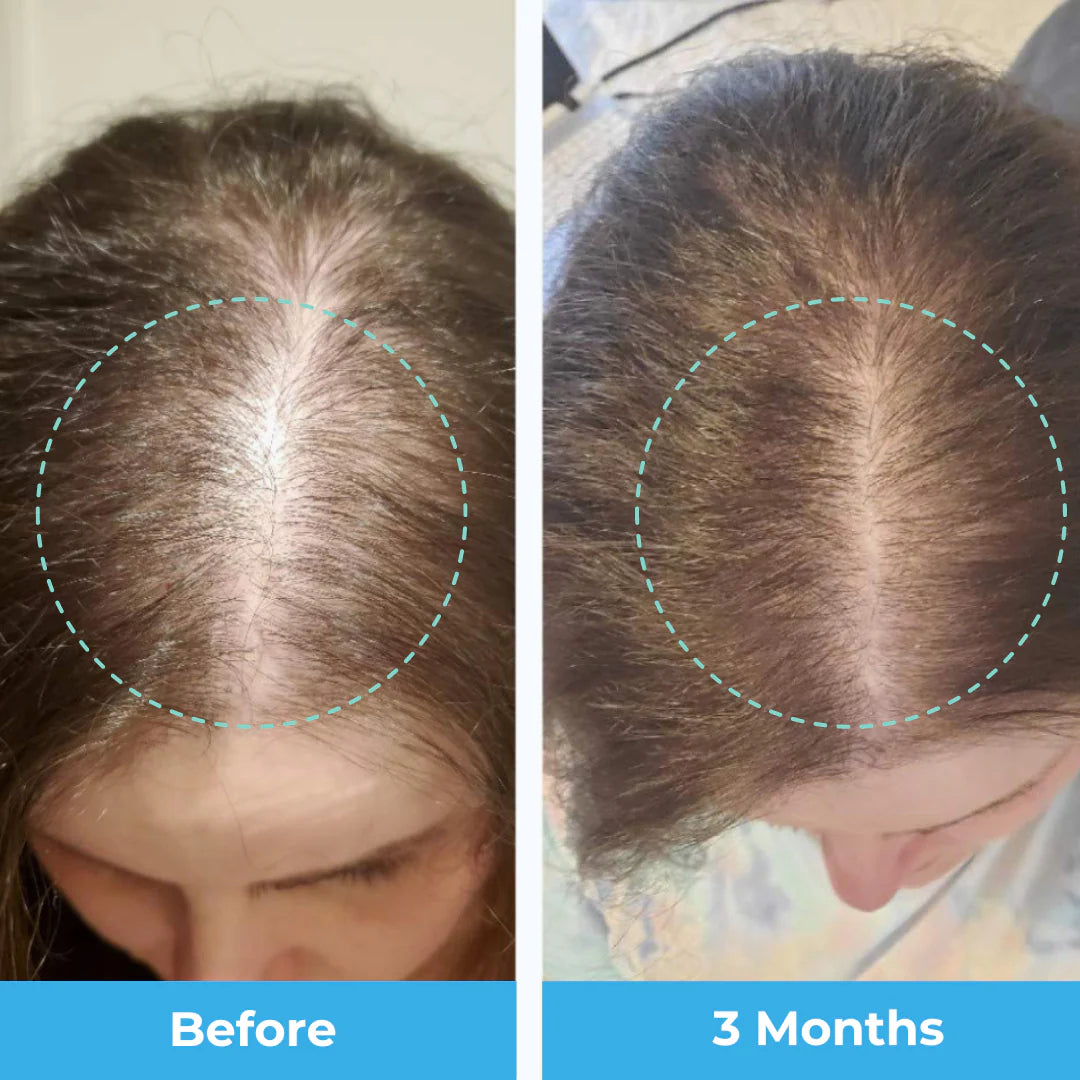 Postpartum Hair Loss Vitamins